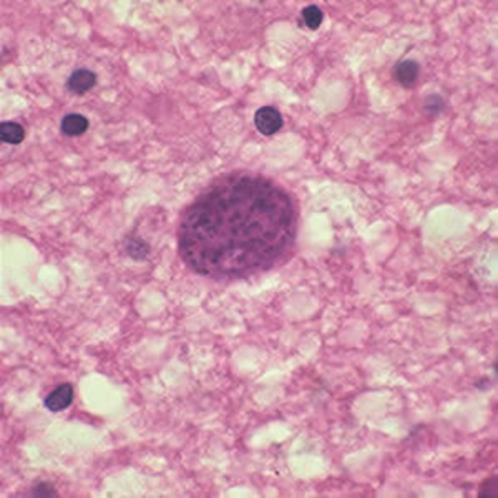 T_gondii_cyst_brainCreditDPDx-Center for Disease Control 